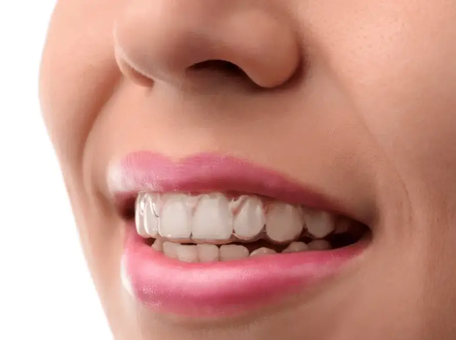 Clear Aligners Treatment